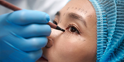 Asian blepharoplasty