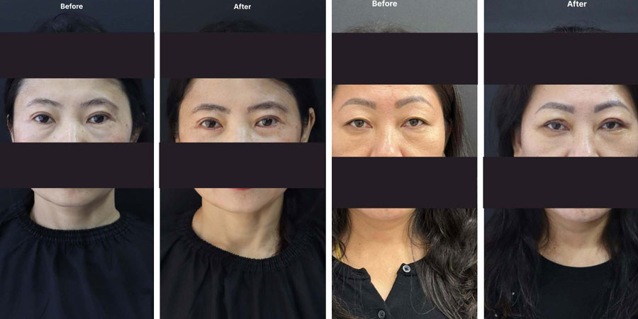 Blepharoplasty