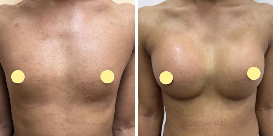 Breast Augementation Surgery in Jaigaon