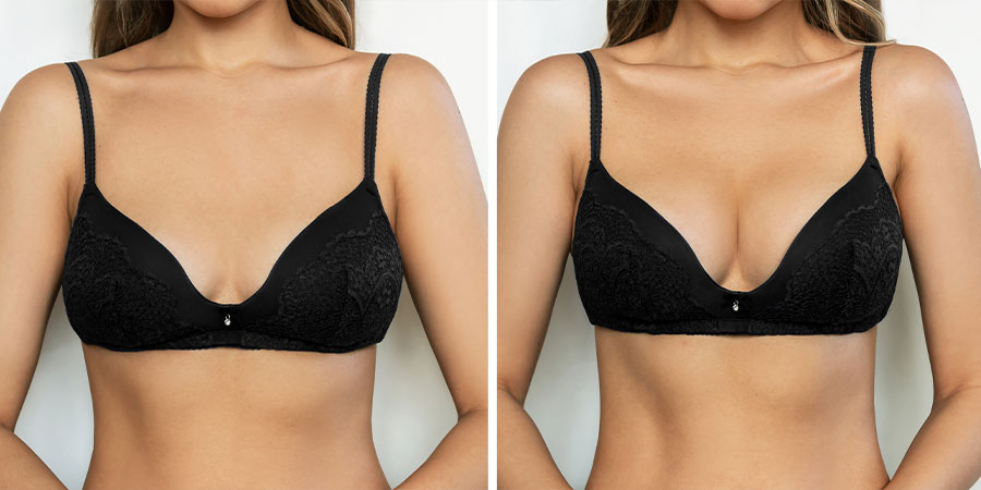 Breast Reduction Surgery