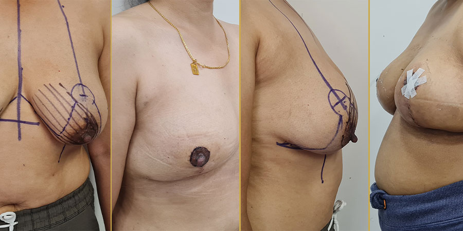 Breast Reduction Surgery