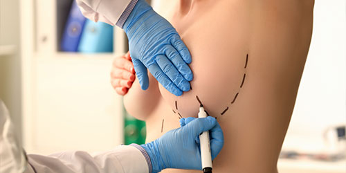 Breast reduction