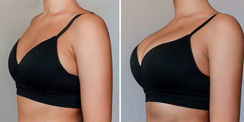 Breast Symmetry Enhancement