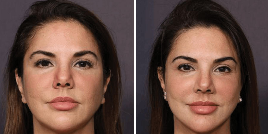 Facelift