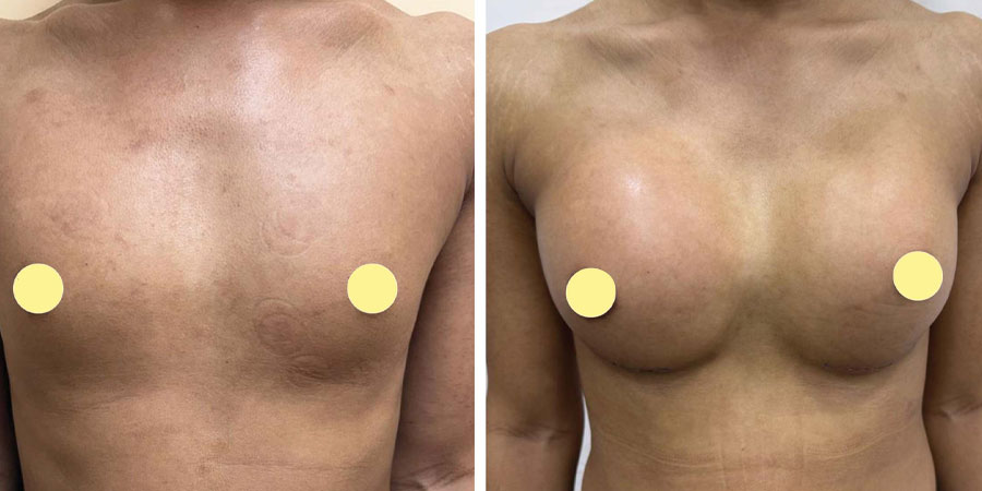 Ideal Candidate for Breast Surgery