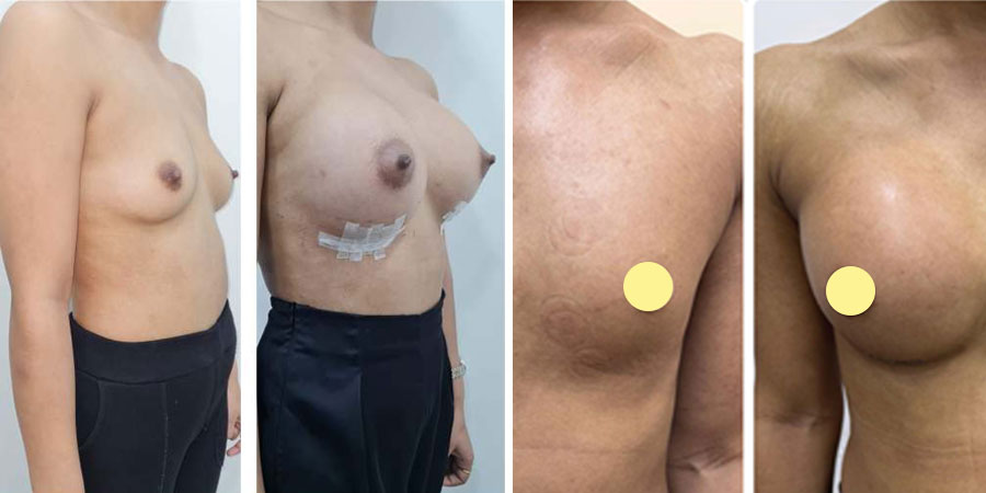 Ideal Candidate for Breast Surgery