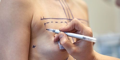 Inverted Nipple Correction