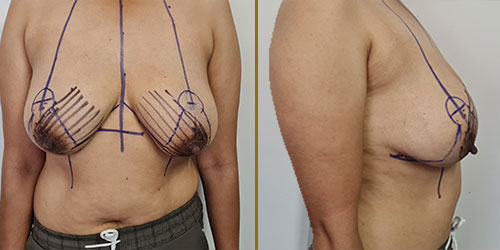 Liposuction-Only Reduction
