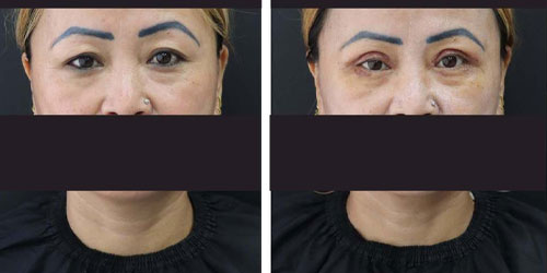 Lower eyelid surgery