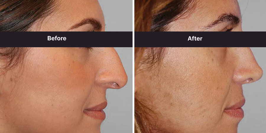 Rhinoplasty Surgery in Thimphu Bhutan