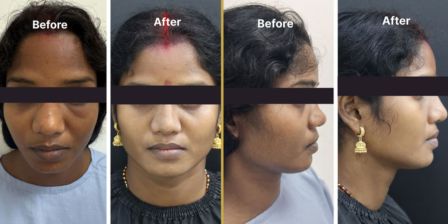 Rhinoplasty