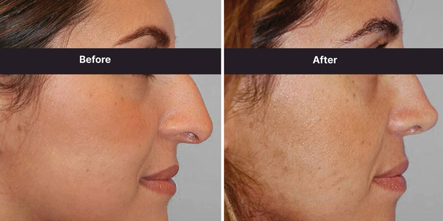 Step-By-Step Rhinoplasty Procedures