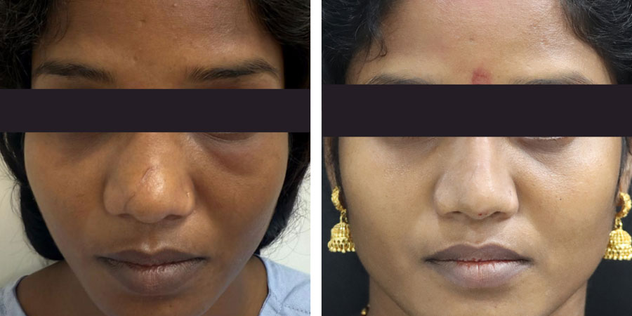 urgical or Non-Surgical Rhinoplasty