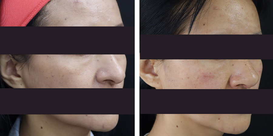 Surgical Rhinoplasty