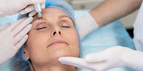 Upper eyelid surgery