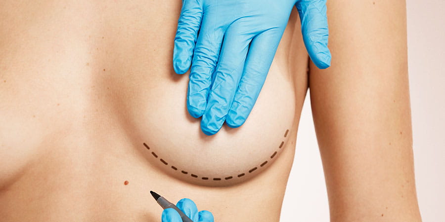 Breast Lift