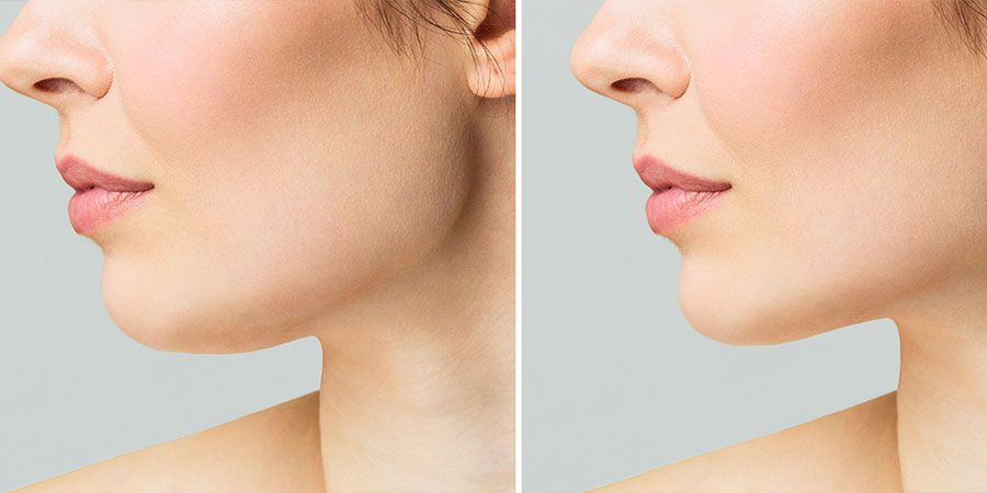 Chin Augmentation