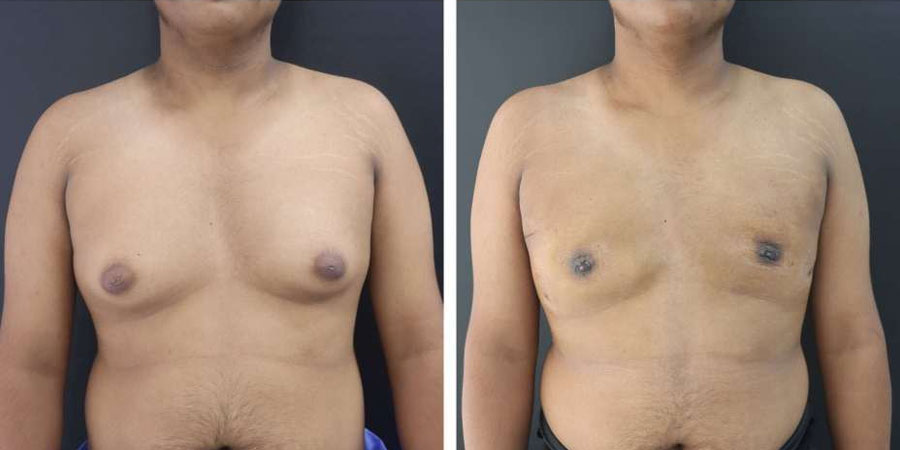 Gynecomastia