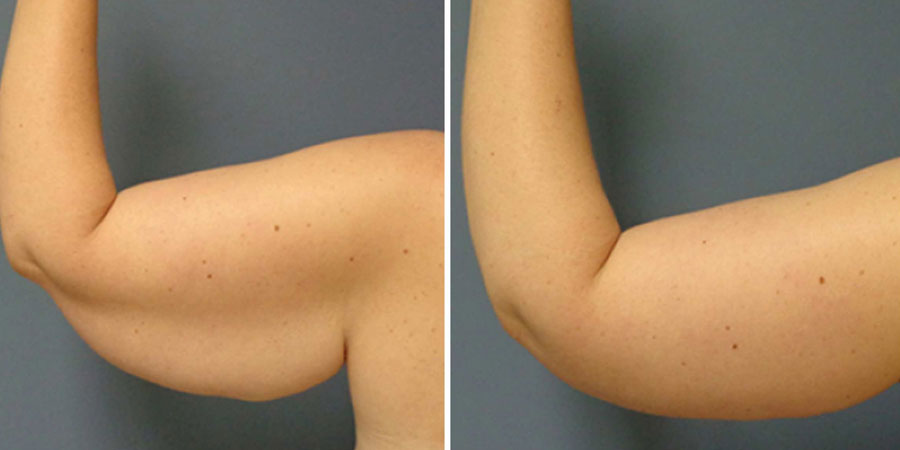 Arm Lift