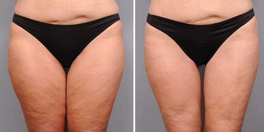 Thigh Lift